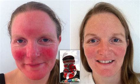 Teacher With Severe Rosacea Is Cured By A Cream Containing Capers