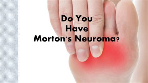 Mortons Neuroma — Foot And Ankle Of West Georgia