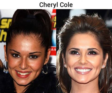 23 Before And After Photos Of Celebrities That Prove Good Teeth Can