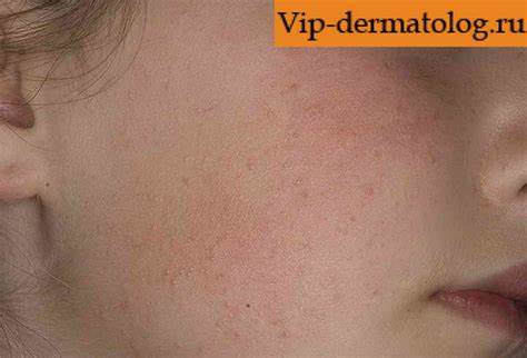 Фолликулярный кератоз диета