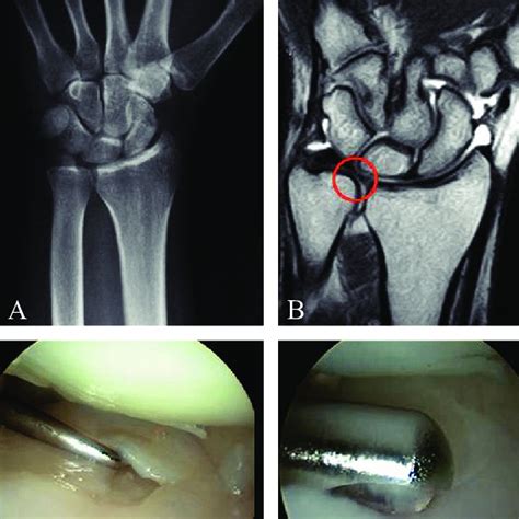 Central Left Wrist Tfcc Tear A Antero Posterior Radiograph B Mri Download Scientific