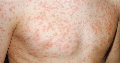 13 Causes Of Non Itchy Rash