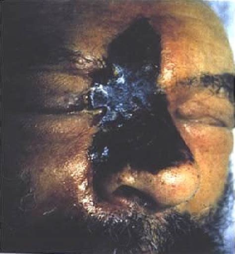 Lecture on mucormycosis by prof david denning (univeristy of manchester, uk) for life worldwide. Necrotic facial eschar of a patient with rhinocerebral ...