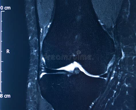 Knee Injury Mri Mcl Tear Stock Photo Image Of Joint 154980478