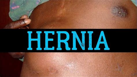 Hernia Symptoms Women Hernias Causes Types And Treatments A