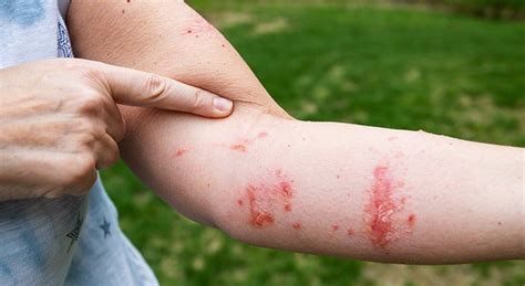 How Do I Know If I Have Poison Ivy Louisville Ky Norton Healthcare