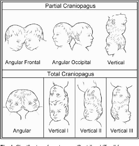 Figure 1 From The Craniopagus Malformation Classification And