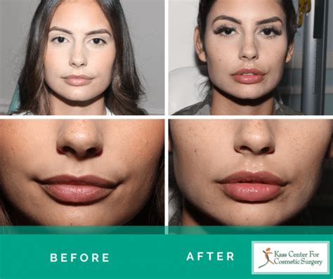 botox to lips before and after