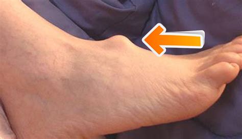 However, there is no scientific evidence to prove their efficacy in treating this condition. ganglion cyst pain | Ganglion Cysts | Information ...