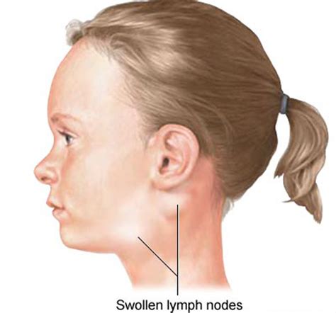 Swollen Lymph Nodes Infectious Diseases Epharmapedia