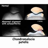 Patellofemoral Chondromalacia Treatment Photos