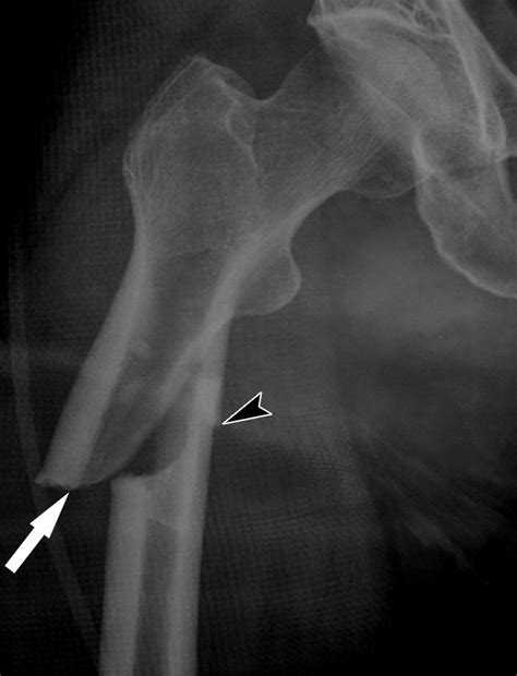 Detection Of Prefracture Hip Lesions In Atypical Subtrochanteric