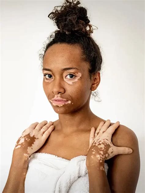 Cure Vitiligo At Home In Just 30 Days Kayakalp Global