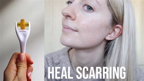 Ultimate Guide To Healing Acne Scars Youtube