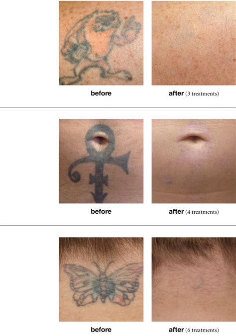 Picosure Laser Tattoo Removal New York Dermatology Group