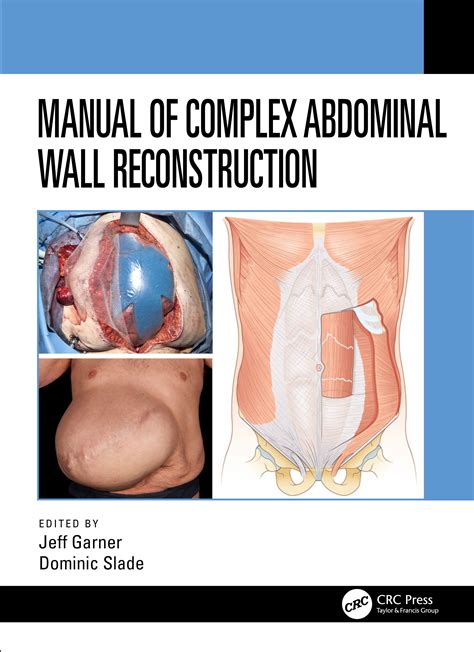 Manual Of Complex Abdominal Wall Reconstruction Taylor And Francis Group