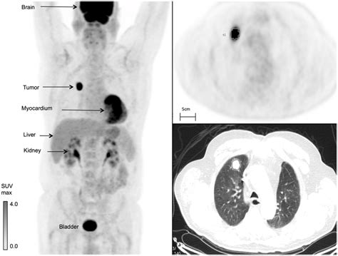 Non Small Cell Lung Cancer Fdg Pet Ct Imaging Features A Three