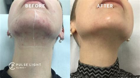 Laser hair removal is more than just ''zapping'' unwanted hair. Laser Hair Removal London | Pulse Light Clinic London