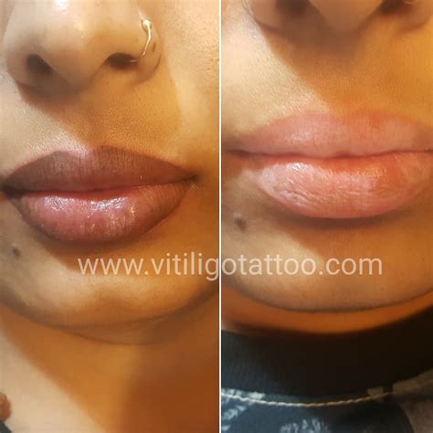 Hey, welcome to our website. Permanent Makeup For Vitiligo In India | Saubhaya Makeup