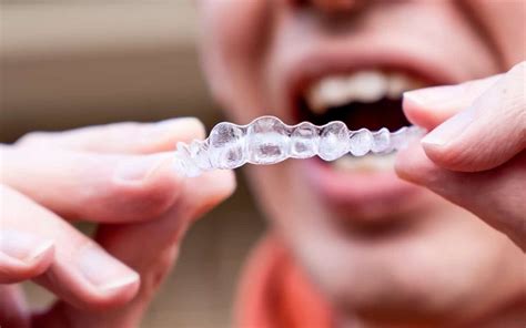 5 Common Myths About Invisible Braces Clear Aligners