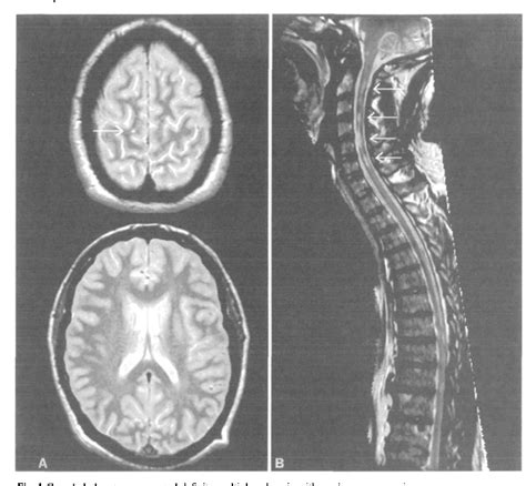 Spinal Cord Mri In Clinically Isolated Optic Neuritis Journal Of My