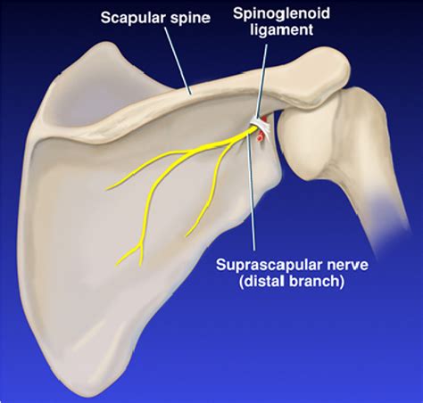 Cureus Persistent Shoulder Pain Due To A Suprascapular Nerve Injury