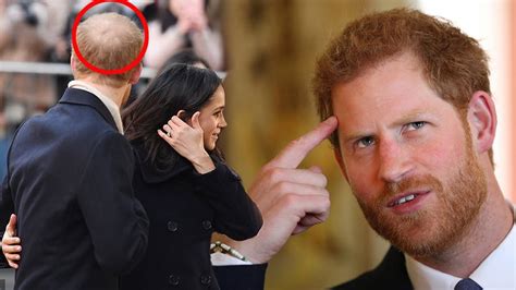 Prince Harrys Hair Loss Is Spreading Before Royal Wedding Expert