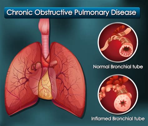 Diagrama que muestra enfermedad pulmonar obstructiva crónica Vector