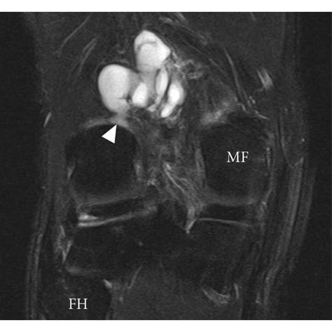 Pes Anserine Bursitis Sagittal Proton Density Fat Saturated Image Of Download Scientific