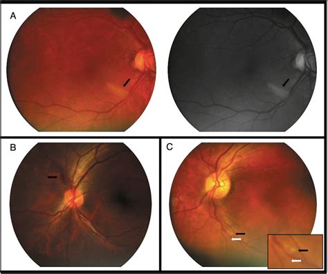 Retinal findings in hospitalised patients with severe COVID-19 ...