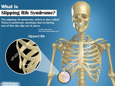 Slipping Rib Syndromecausessymptomstreatmentrecovery Period
