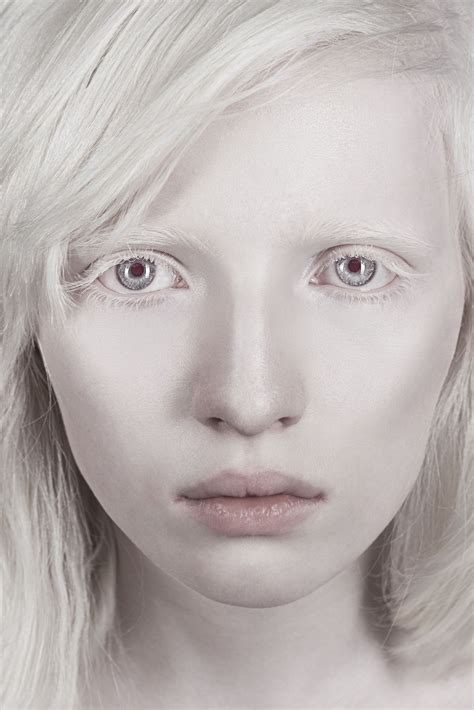 My Lovely Girl By Kumarovamkote Michael Albino Model Albinism