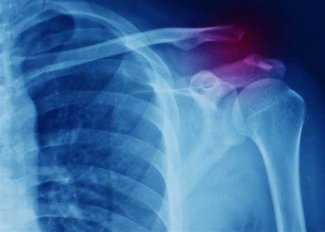 Ac Joint Injury Shoulder Specialist Vail Aspen Colorado Springs