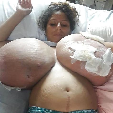 Massive Tits Breast Reduction Porn Pictures Xxx Photos Sex Images