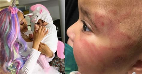 Baby Comes Home From Day Care Bruised And Battered