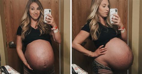 Pregnant With Quadruplets Progression