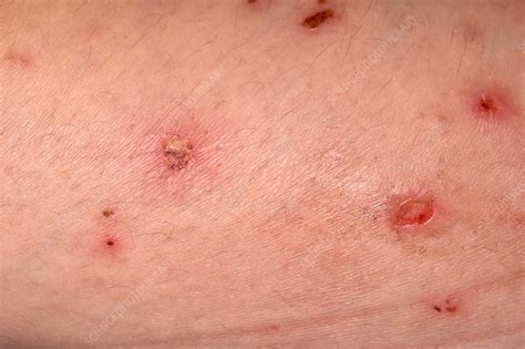 Infected Eczema Rash Stock Image C0345328 Science Photo Library