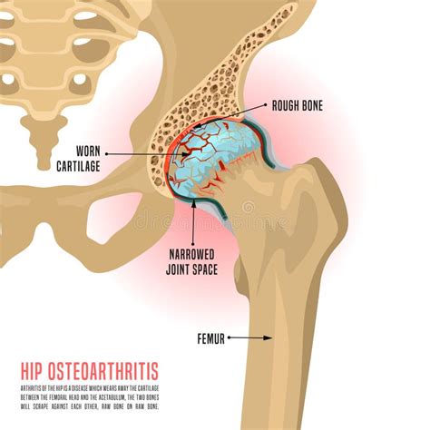 Hip Pain Diagram Photos