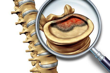 In this tumor, the cancerous cells produce bone. Bone cancer | Symptoms, Diagnosis, Treatment, Prevention ...