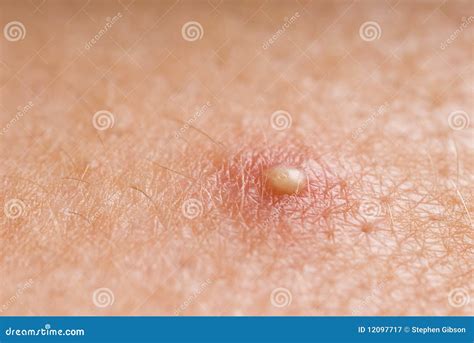 White Head Pimple Stock Image Image Of Pustule Boil 12097717