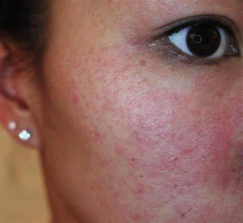 Диета дерматит крапивница Нервный дерматит: крапивница на нервной почве, аллергия и сыпь от Нервный дерматит: крапивница на нервной почве, аллергия и сыпь от Диета дерматит крапивница