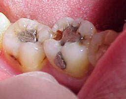 Terutama sakit gigi karena gigi berlubang. Cara Menghilangkan Sakit Gigi Karena Gigi Berlubang - Full ...
