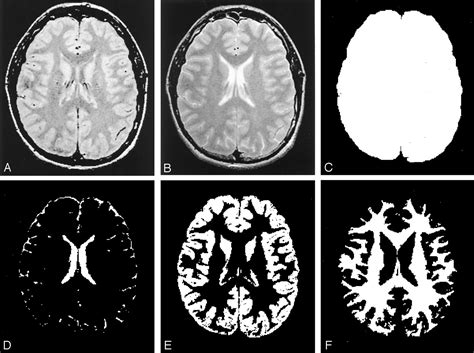 Age Related Total Gray Matter And White Matter Changes In Normal Adult