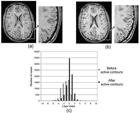 Comparison Of The Two Segmentation Stages On Real Mri T1 Weighted Data