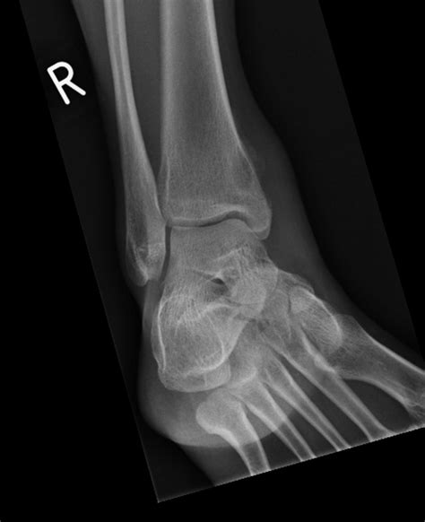 Plain Radiograph Of The Right Ankle Of A 36 Year Old Woman Who