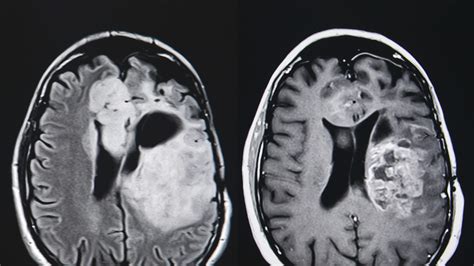 Treating Pediatric Brain And Spinal Cord Tumors Fact Sheets Yale