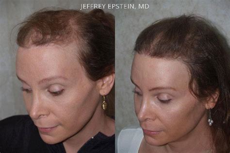 Hair Transplants For Gender Reaffirmation Before And After Photos