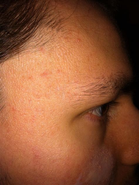 Is It Acne Or Pityrosporum Folliculitis With Pic General Acne My Xxx Hot Girl