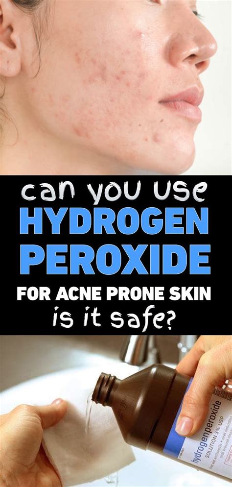 can you use hydrogen peroxide for acne prone skin is it safe acne dryskincareproducts
