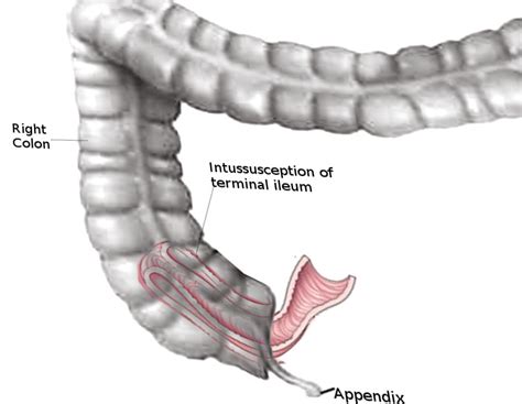 Figure Intussusception Of Small Bowel Image Courtesy Dr Chaigasame